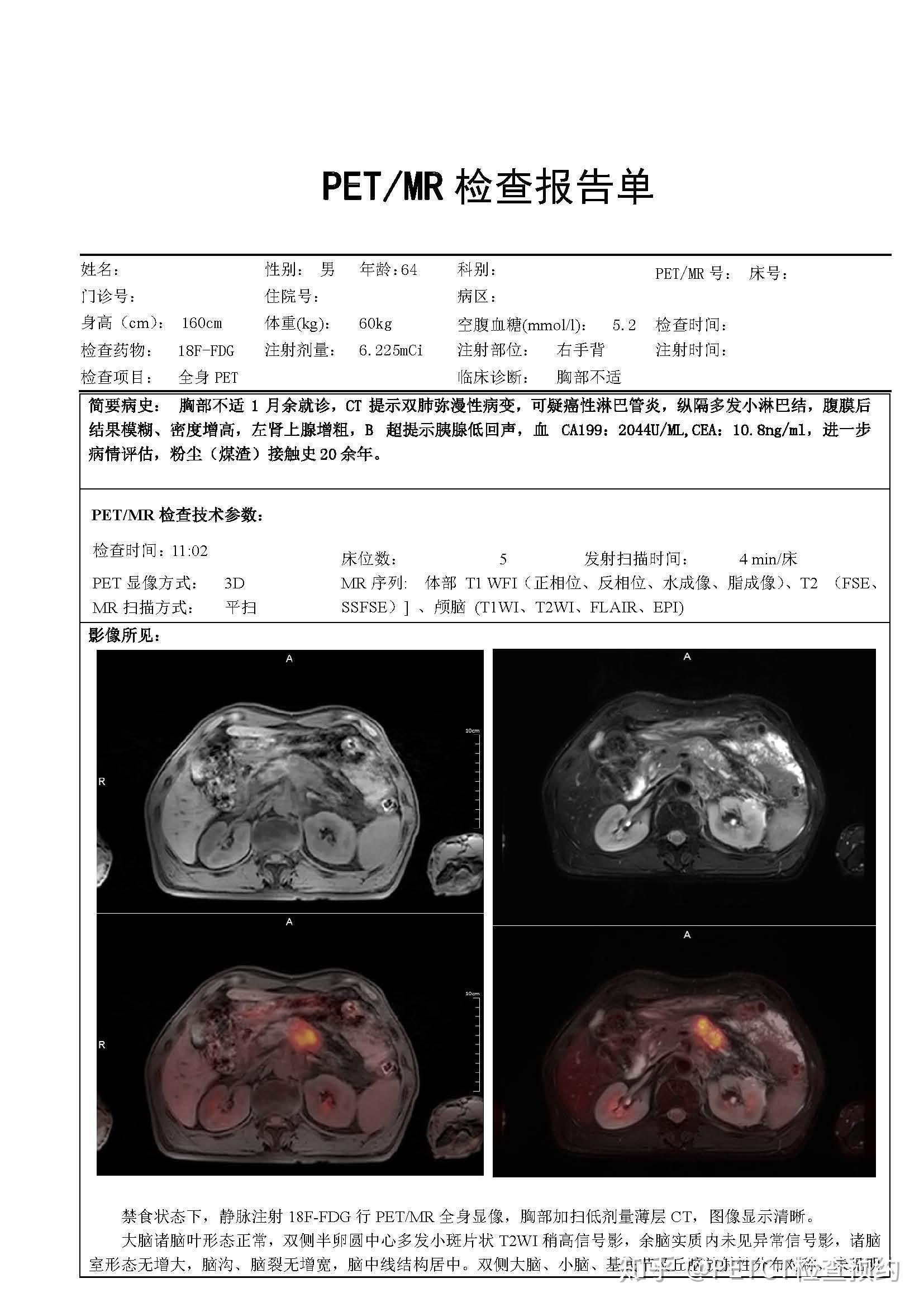 胸部不適1月餘就診ct提示雙肺瀰漫性病變檢查結果為胰腺癌全身轉移pet