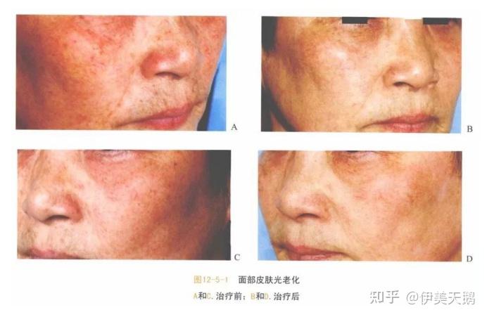 面部色泽晦暗,各种色素性斑点,毛细血管扩张;在内外因素的双重作用下