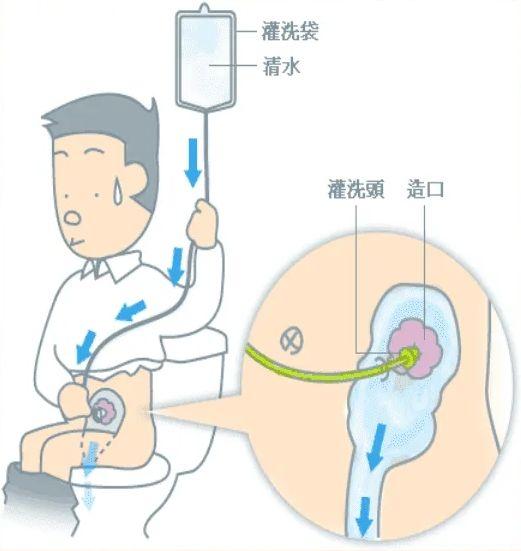 造口还纳术步骤图图片