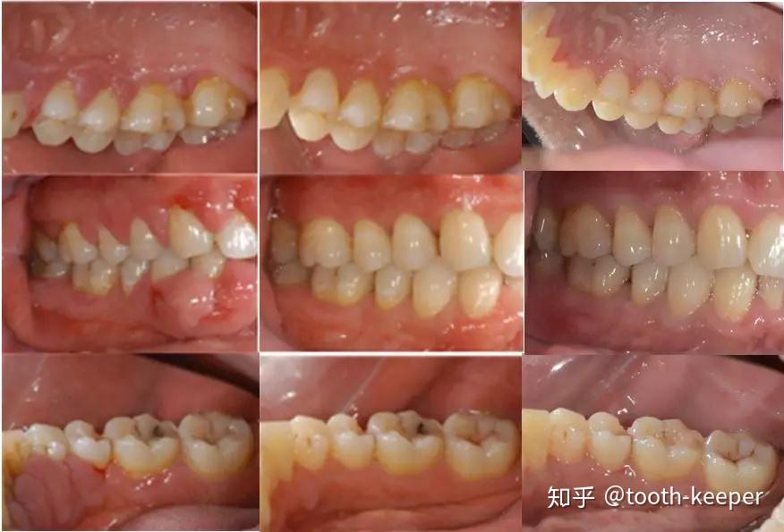 慢性牙周炎伴药物性牙龈增生随访八年病例一例