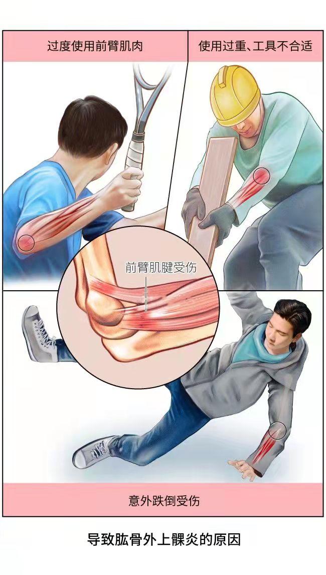 图源:腾讯医典网球肘的正名叫做肱骨外上髁炎,属于肌腱炎的