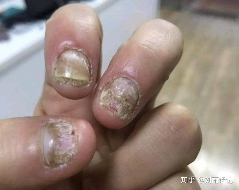 你有灰指甲困扰吗困扰多久了
