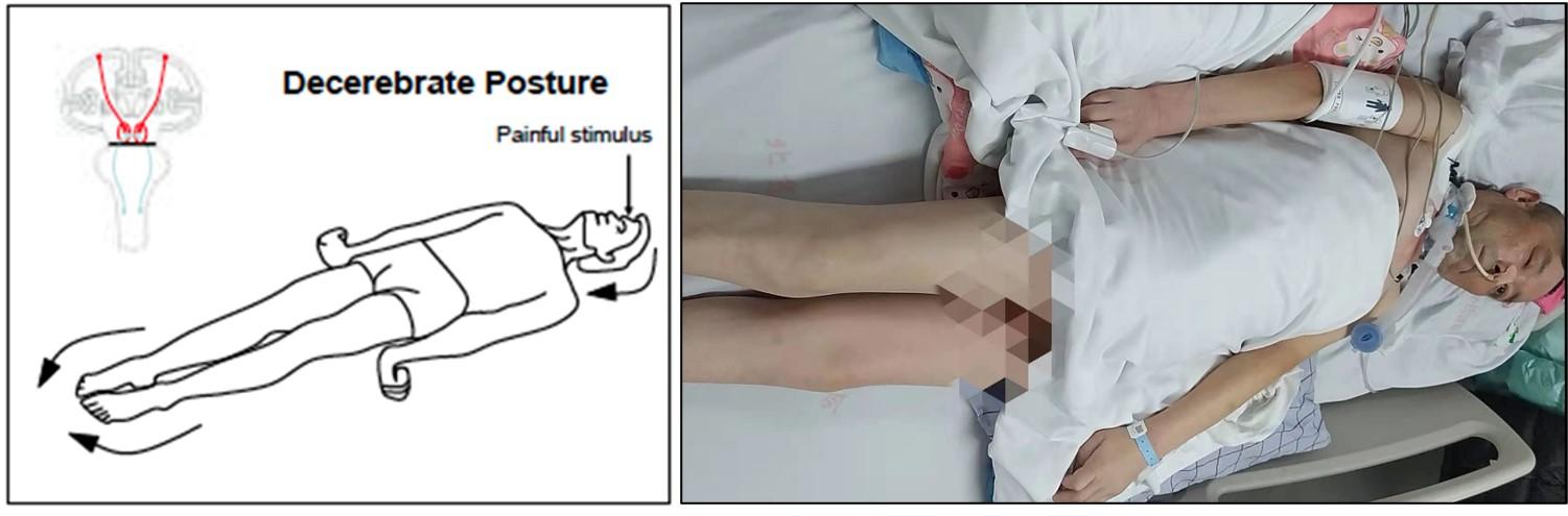 仍然沒有清醒,同時患者表現為在疼痛刺激的情況下,出現角弓反張,即
