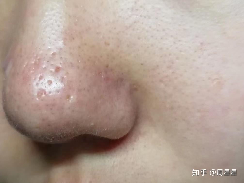 就连之前挤黑头留下的黑头坑也消失了!效果超级明显!