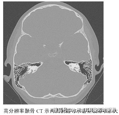 沧州惠耳教你读懂CT片——大前庭导水管综合征的CT影像学诊断 - 知乎