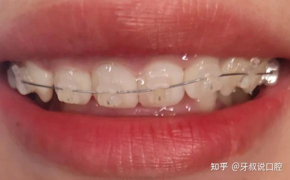 牙齿矫正花多少钱才不算被坑你需要准备多少预算牙齿矫正的费用是怎么