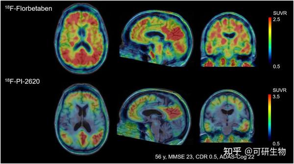 医学科研热点| 阿尔茨海默病tau PET影像诊断 - 知乎