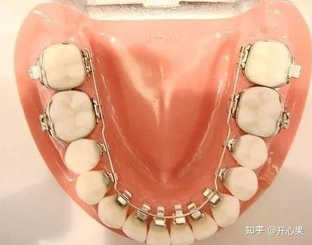 牙齿缝隙比较大,去做牙齿矫正会有改变吗?