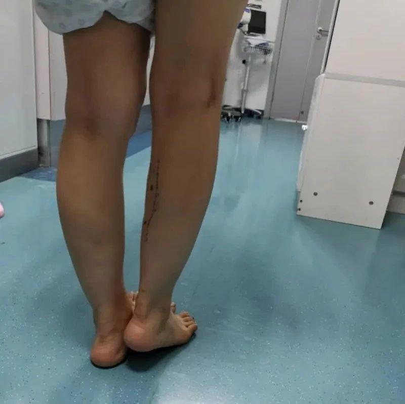 女子花一万多打瘦腿针 结果右小腿竟短了一截 知乎 女子花一万多打瘦腿针 结果右小腿竟短了一截 知乎