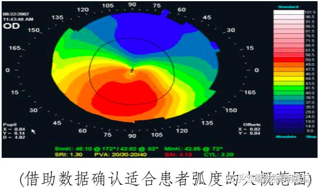 一,上海五官科医院五官科医院薛枫大夫前几年为病人验配巩膜镜,主要是