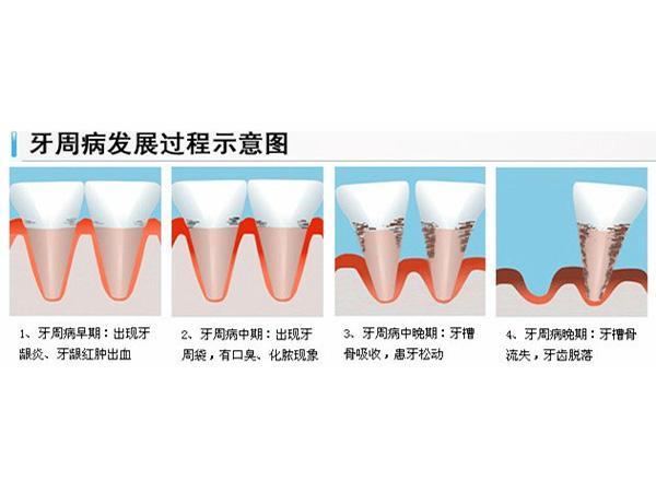 剛剛 牙周炎主要有四個發展階段.