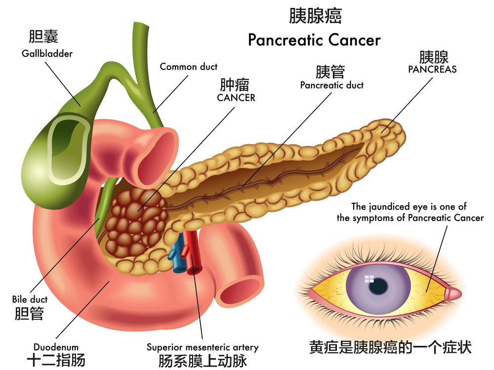 振奮丨眾癌之王胰腺癌可通過曲美替尼聯合帕博西尼治療