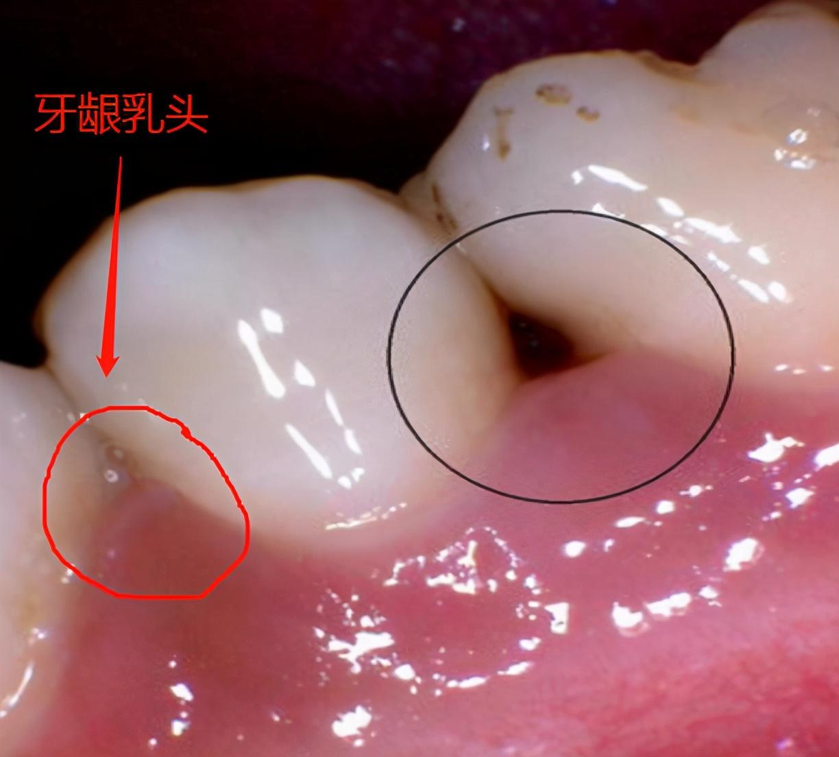 牙龈乳头炎怎么治疗图片