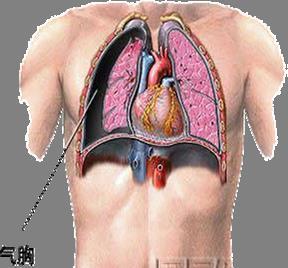 气胸的诊治与护理 知乎