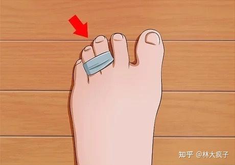 1,为了防止鞋子把脚磨起泡,脱皮,可以用斜纹棉胶布贴在鞋内侧.