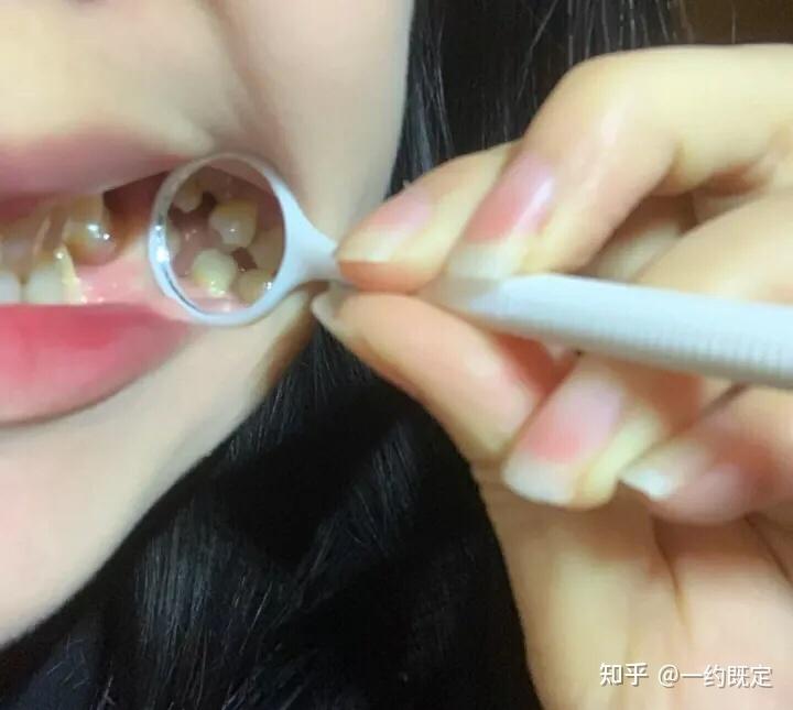 三颗门牙的长沙种植牙完工 - 知乎