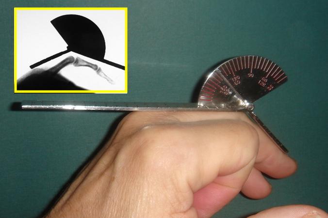 goniometer ,关节活动度量角尺常用的关节活动度量角器大盘点因为使用