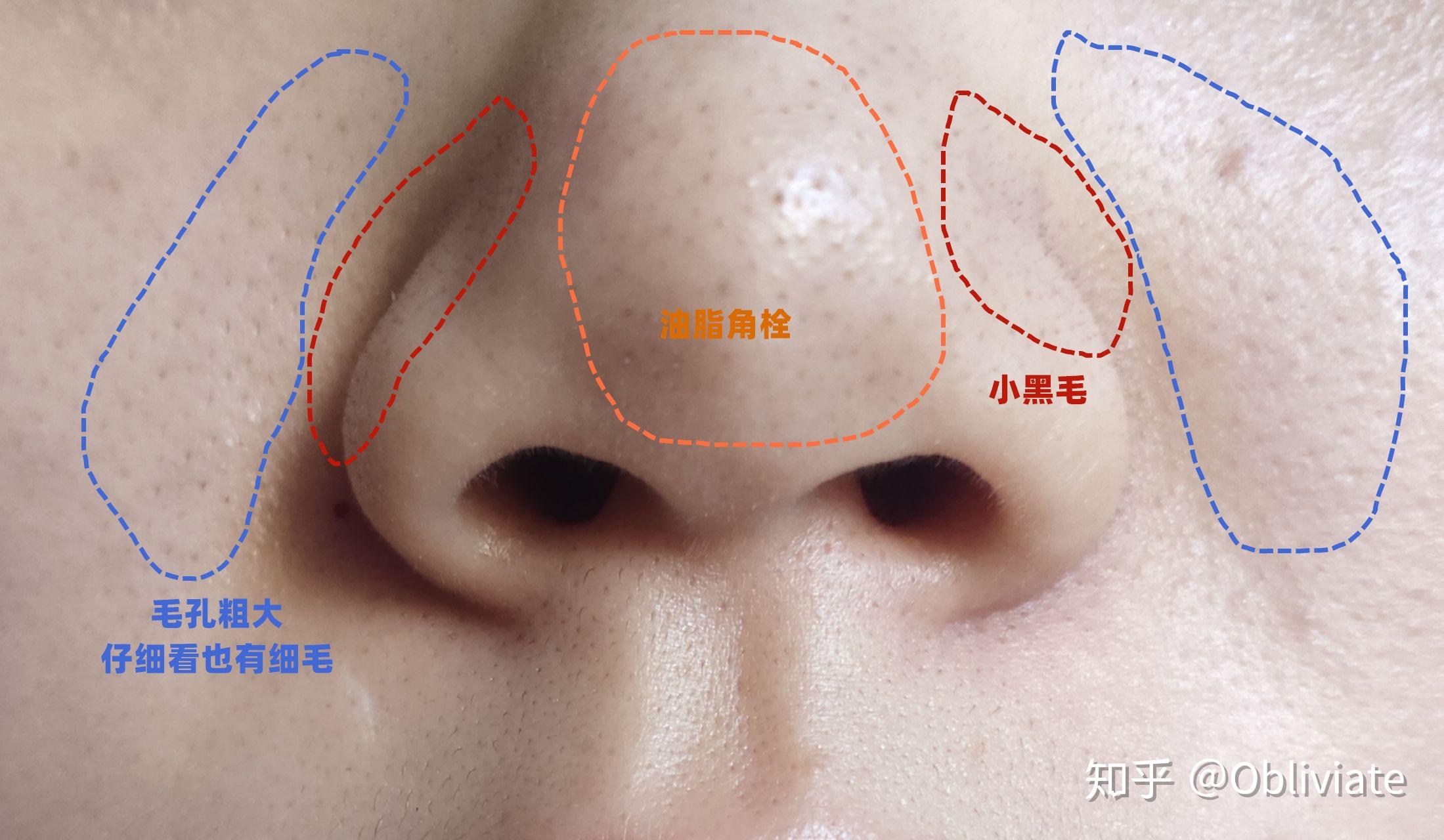 安安粉刺露的真实测评，附加消除闭口粉刺、黑头、红鼻窝的方法