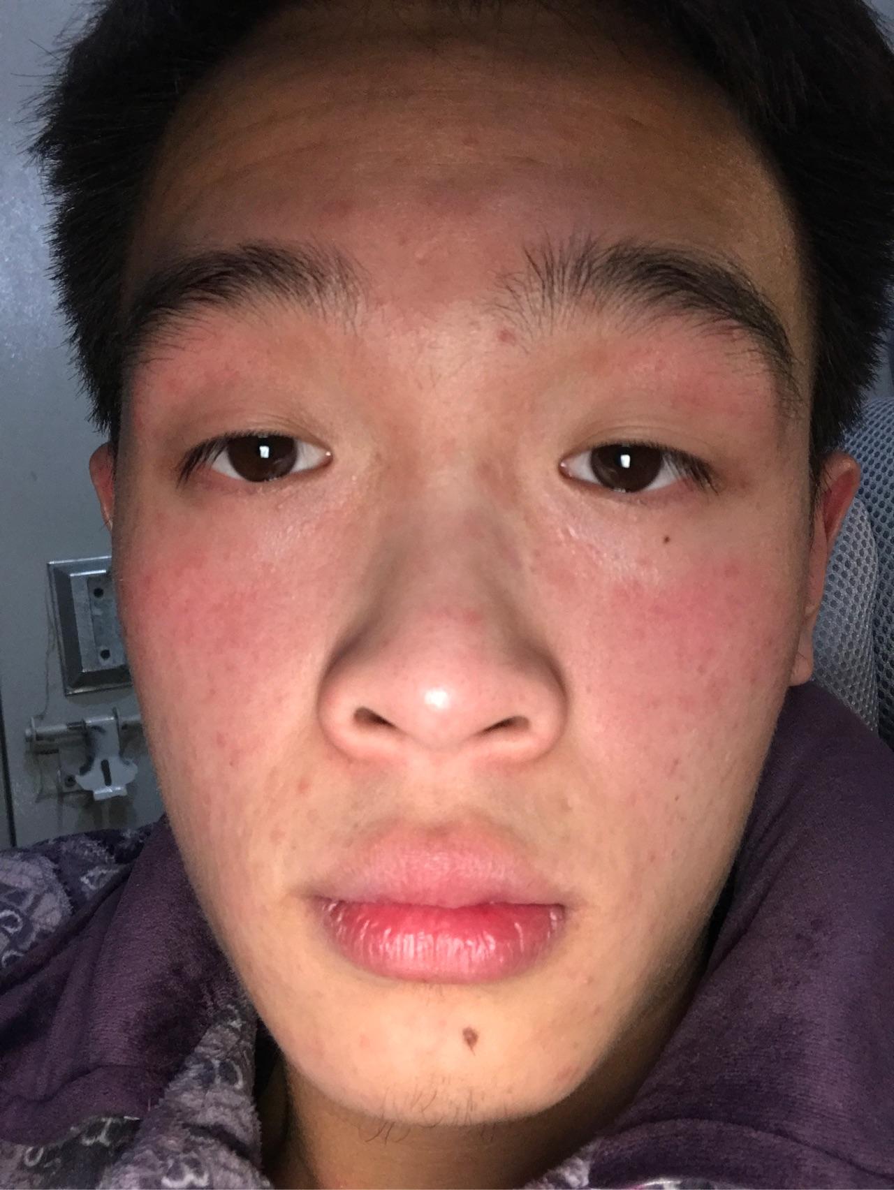 脸上红痘痘怎么去除? - 包志伦的回答 - 知乎