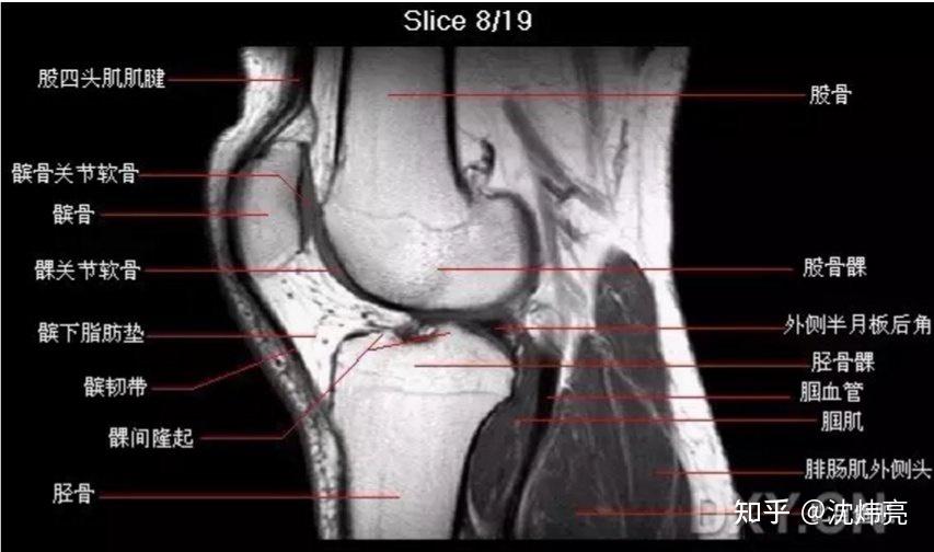 膝关节CT解剖图图片