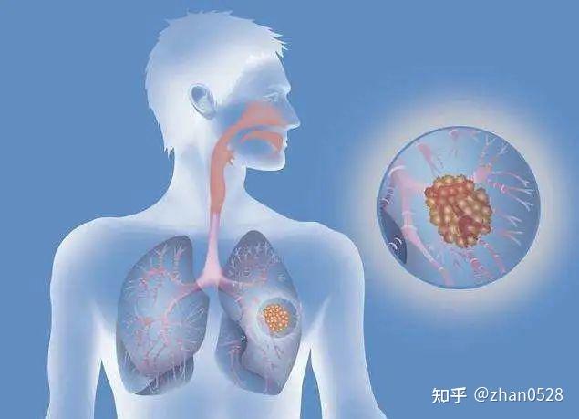 支气管炎是怎么一步步发展成慢阻肺、肺气肿的？ - 知乎