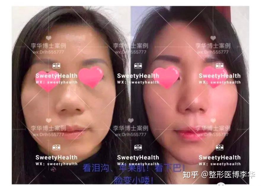 SVF脂肪胶填充案例分享 - 知乎