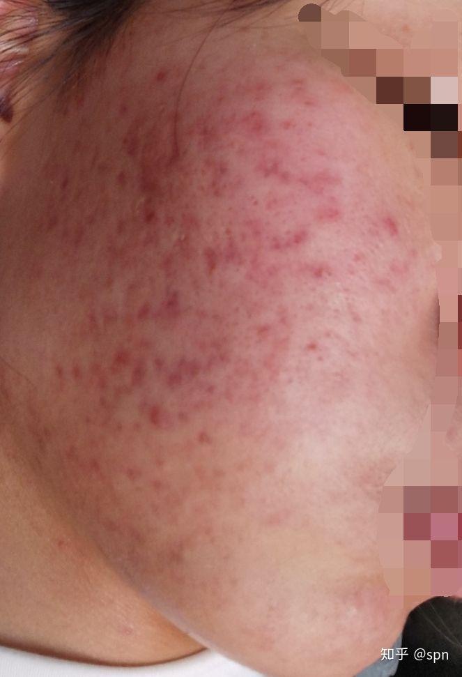 医用面膜对油性敏感痘痘肌真有那么多好处吗