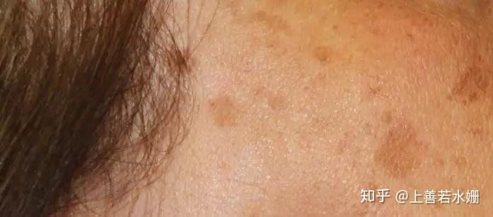 不能被清除的死细胞和脂肪等内含物形成褐色脂质体堆积,即老年斑[3]