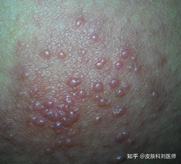 身体上哪些部位爱发湿疹?患了湿疹日常如何护理? - 知乎