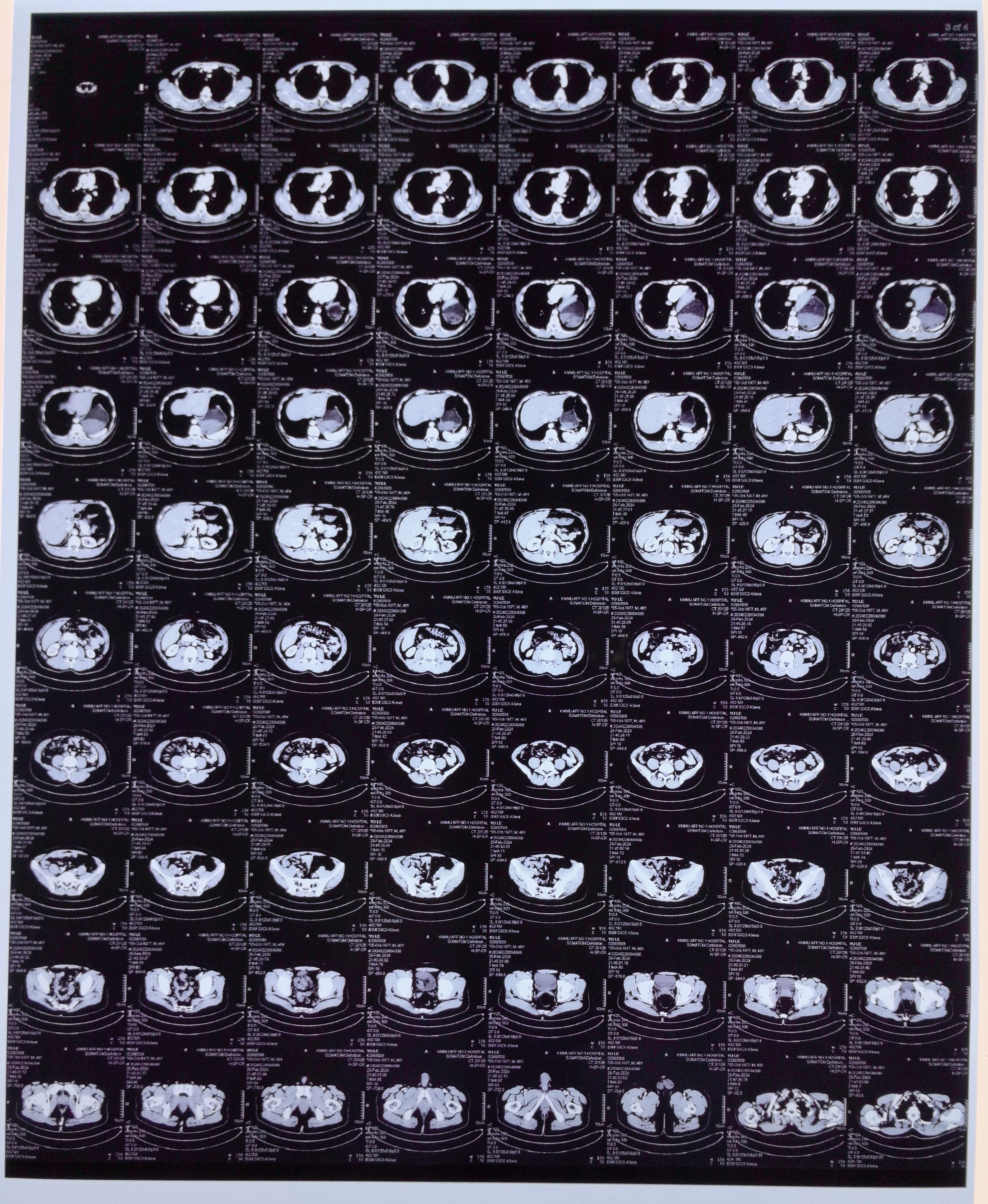 胸腺癌治疗那些事二十术后第17个月复查情况