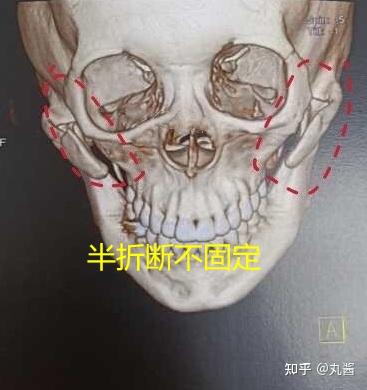 颧骨内推半折断不固定好还是全折断双端固定好？国内哪些医生做颧骨内推？ - 知乎