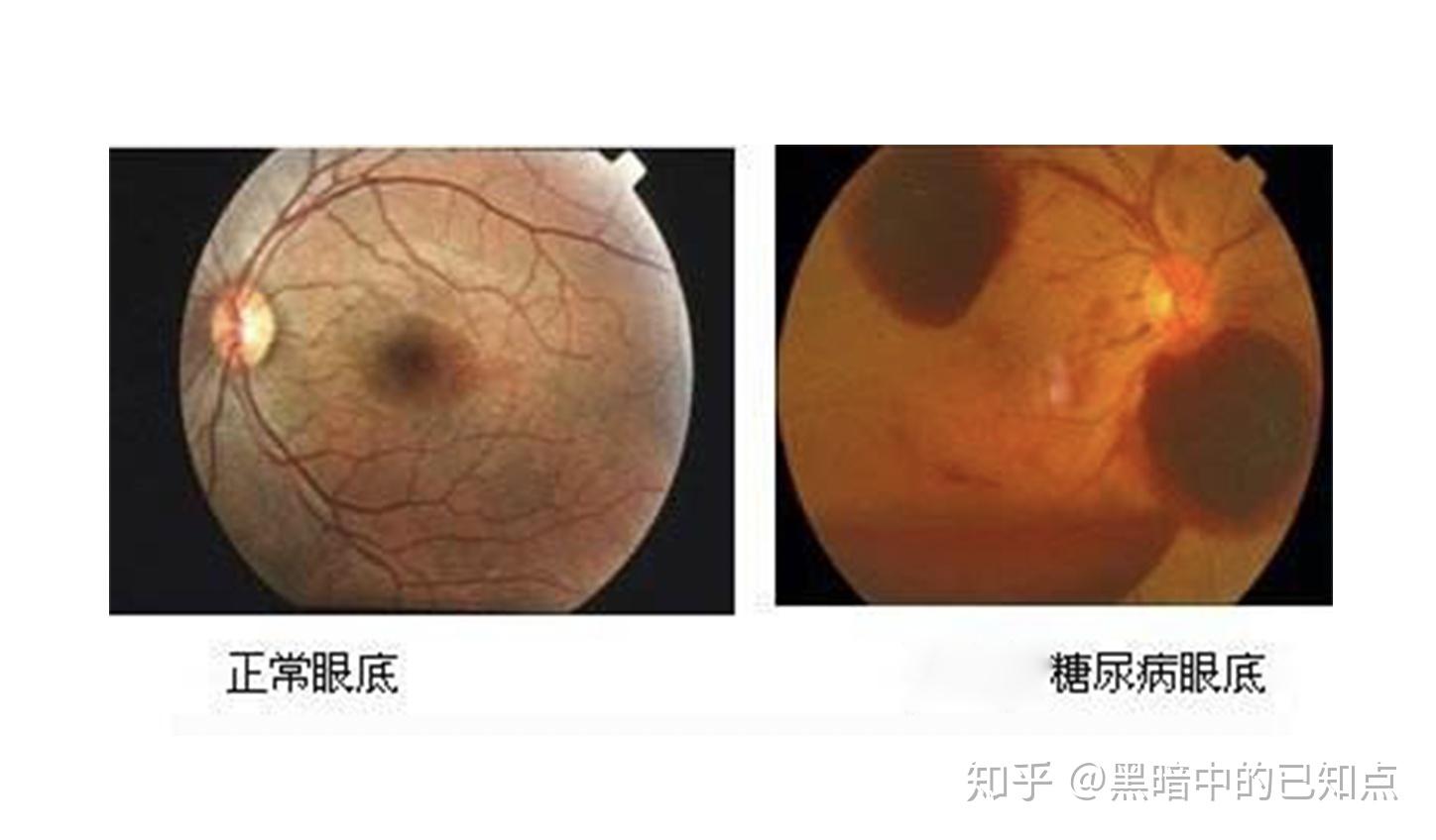 春节眼病预防早知道_眼睛_视力_视网膜