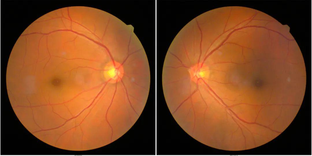 航天员在太空摸黑也要做的眼底检查到底是什么