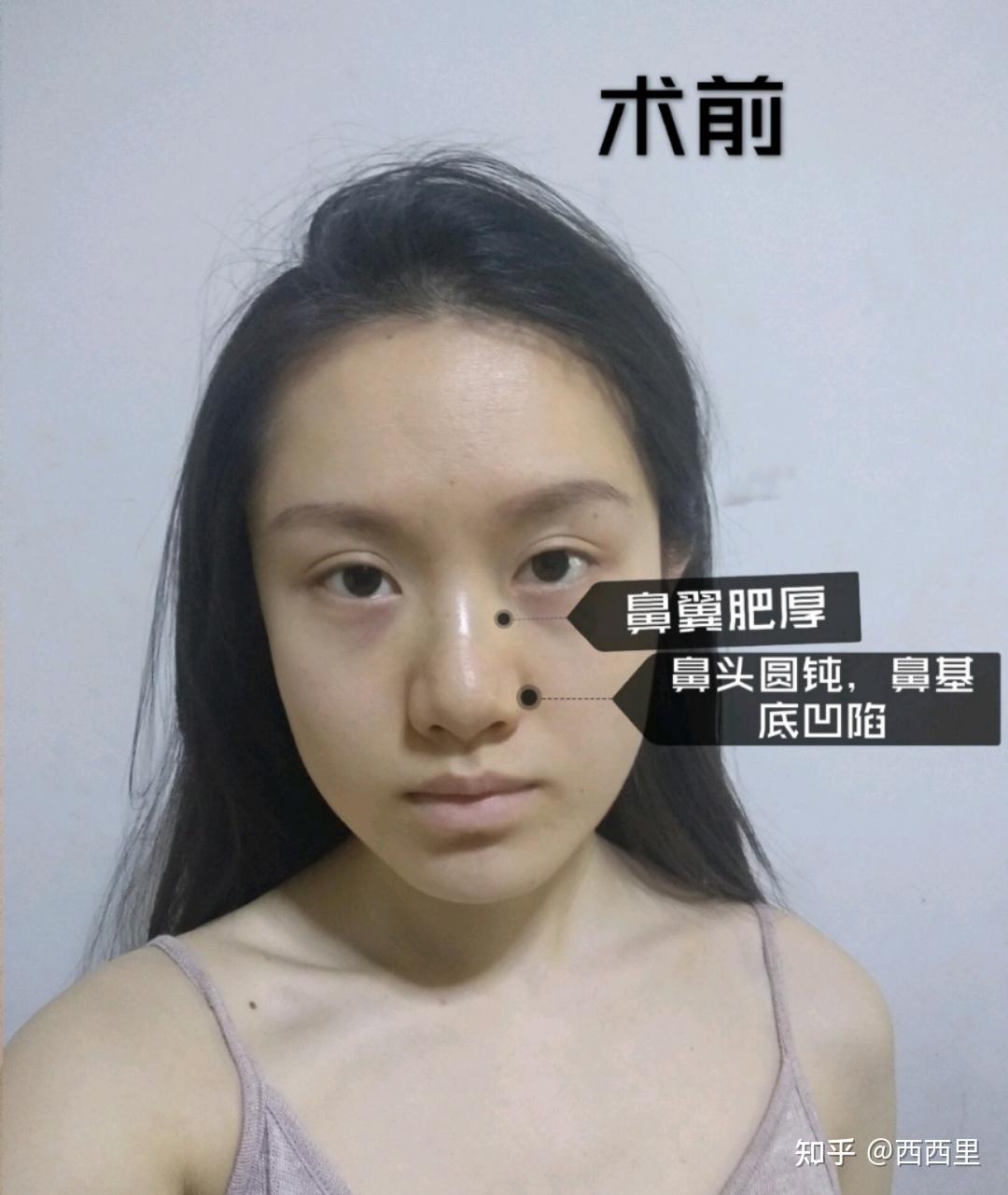 上海爱莫儿医疗美容肋软骨隆鼻怎么样_恢复过程_效果如何_娜娜小花花整形日记4.21_新氧美容整形
