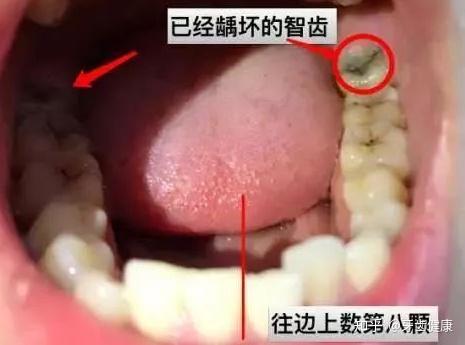 微创拔牙丨抓住时机 告别磨人的 小妖精 知乎