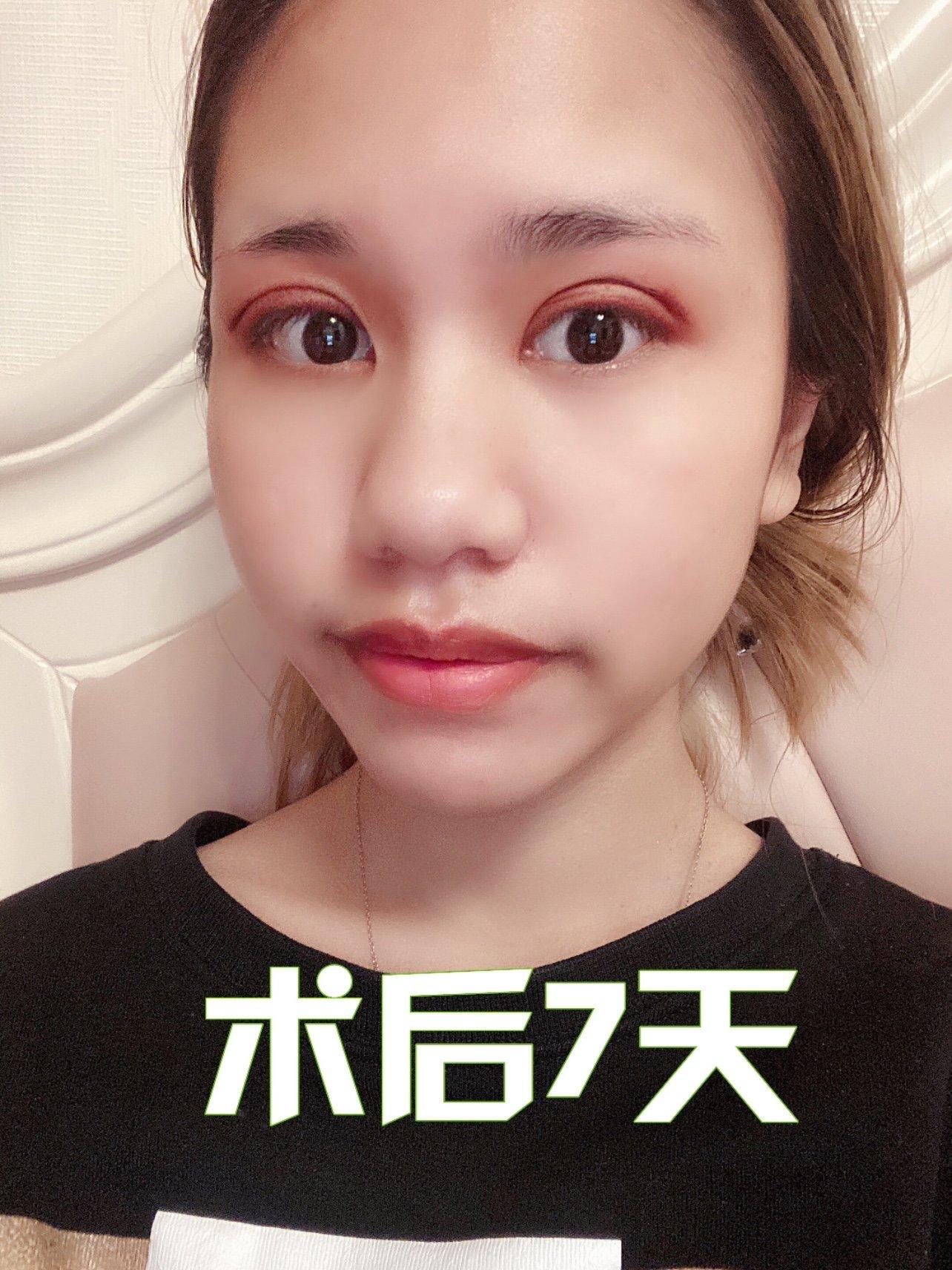 全切双眼皮-案例分享! - 知乎