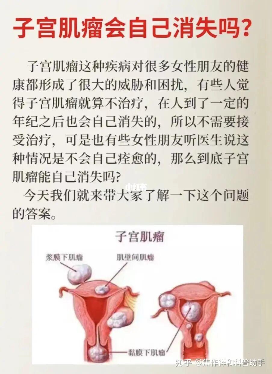 子宫肌瘤是什么?会自己消失吗?