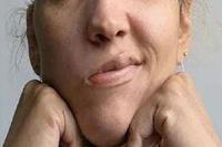 是什么引发的面瘫