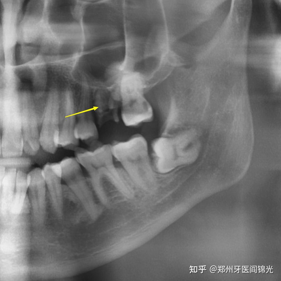 残根残冠的保留-童忠春的博客-KQ88口腔博客