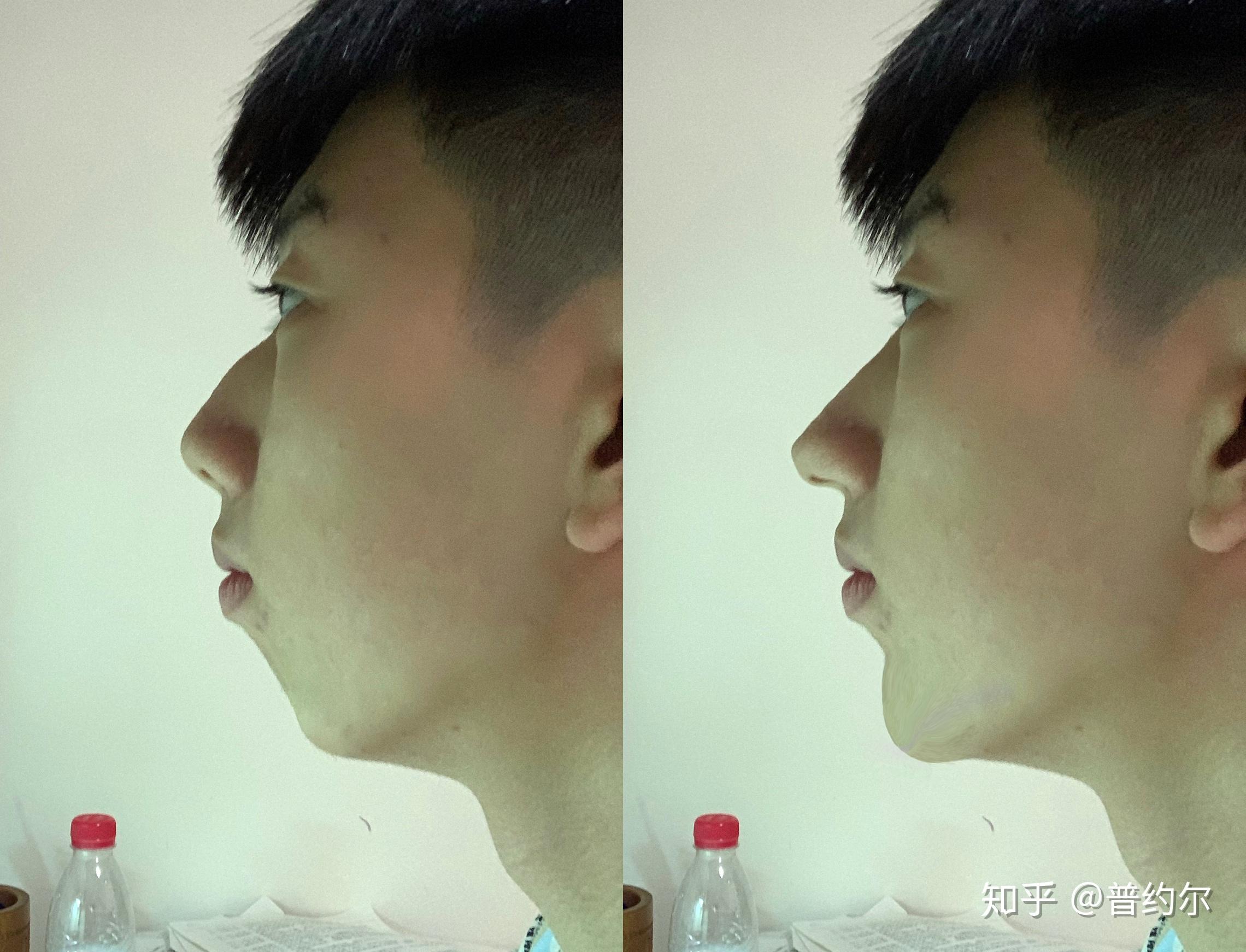 下巴后缩加驼峰鼻都快要自卑死了平时都不敢楼侧脸给别人看怎么才可以