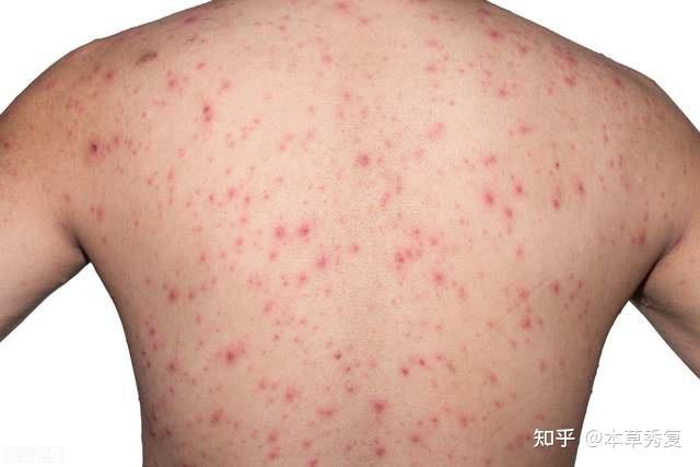 背上长痘痘和脸上长痘痘的原因一样吗