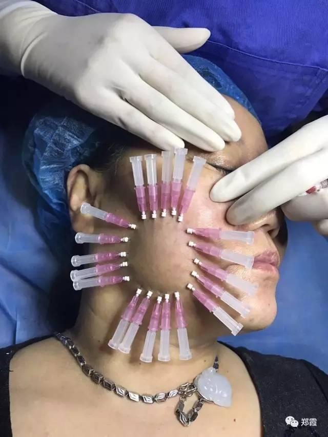 什么是线雕?蛋白埋线提升后的注意事项?可以保持多久?