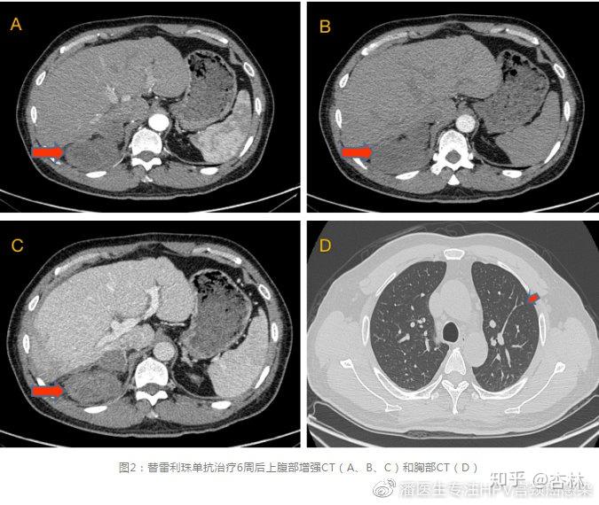 病例分享无进展生存期达14个月免疫治疗复发转移肝细胞癌一例