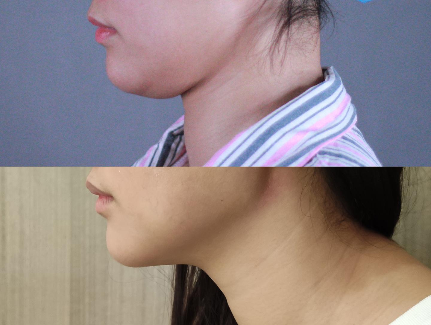 黄金微雕去双下巴效果如何是永久的吗