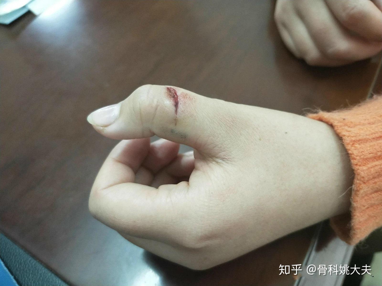 手指被划伤贴上创口贴就不管了差点手指就废了