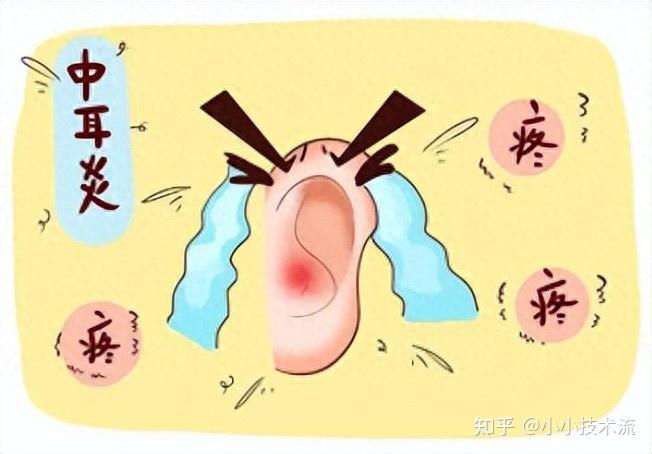 别再交智商税!中耳炎适配耳机,关键看这3点就够了