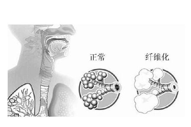 肺纤维化如何选购制氧机看完你就懂了