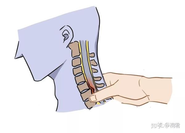 3.一指禪推頸項部