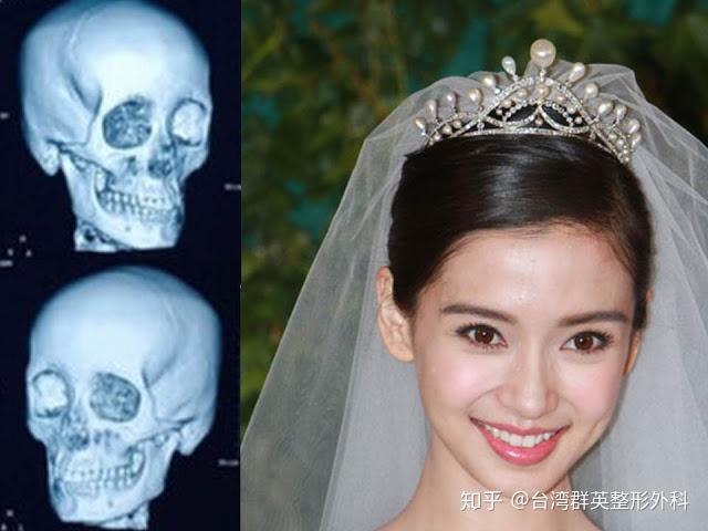 angelababy的整形鑑定