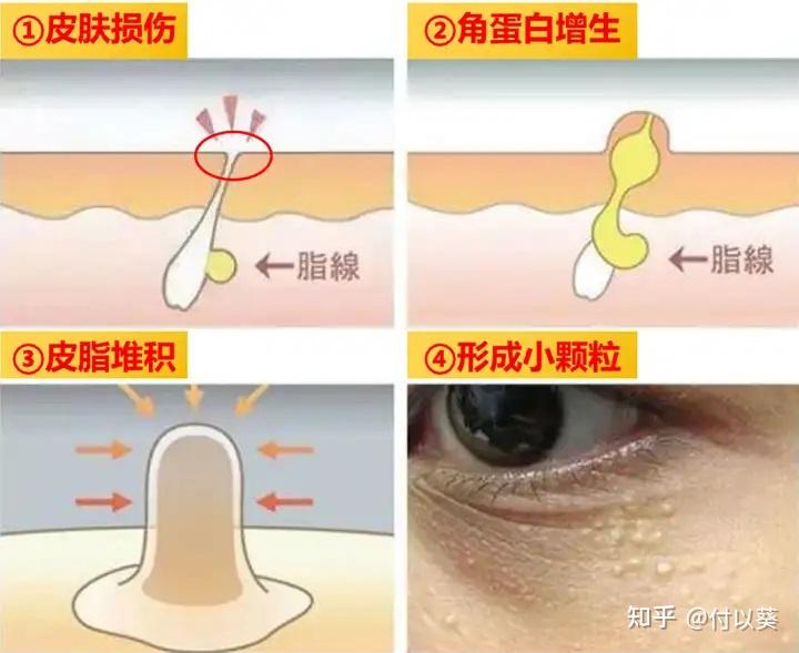 什么方法可以去眼边上的脂肪粒 v2-8fec080c4d1bdc0ac274ea732b575377_r.jpg